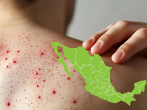 Morir de sarampión en 2026 es una tragedia.